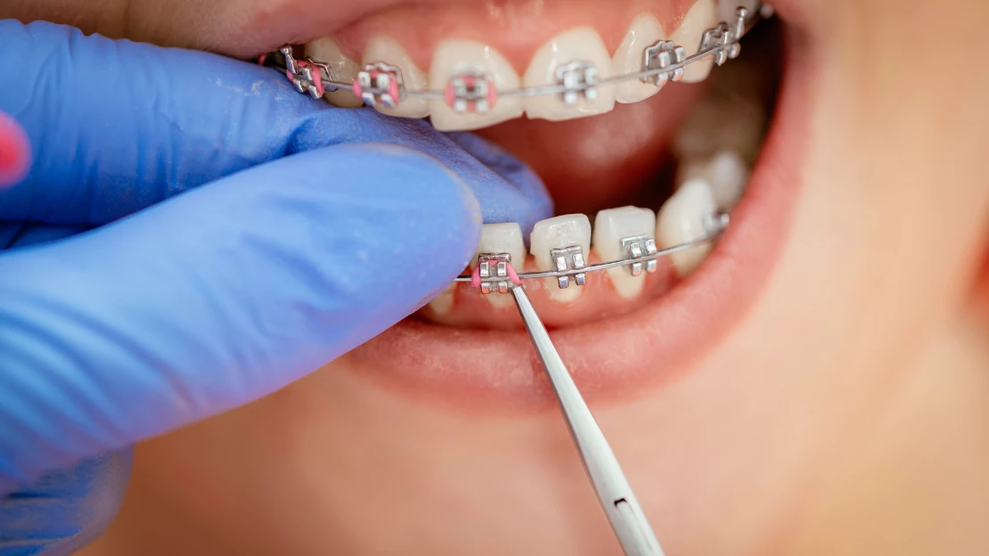 Common Braces Wires Risks, Problems, and At-Home Solutions
