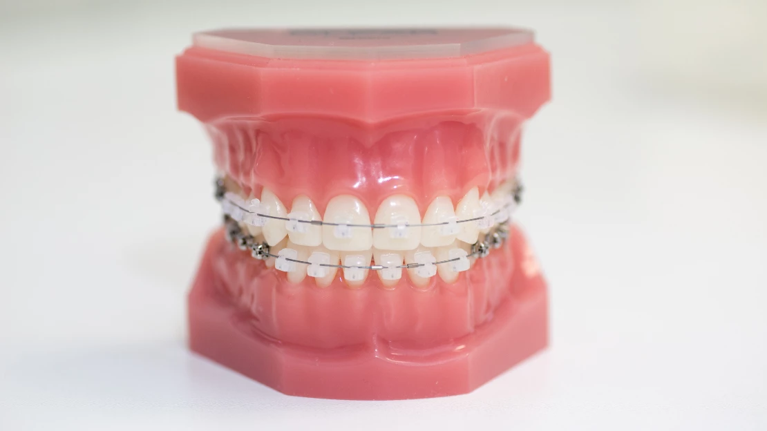 SEO Ceramic Braces