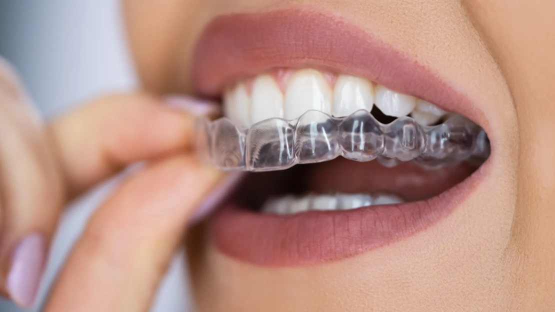 SEO Blog Invisalign for Adults & Teens